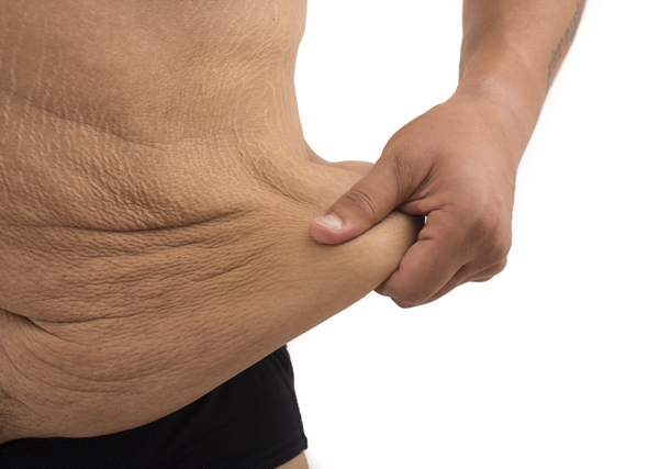 Cara Cegah Kulit Kendur Setelah Turun Berat Badan