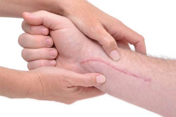 Cara Hilangkan Bekas Luka dengan Bahan Alami