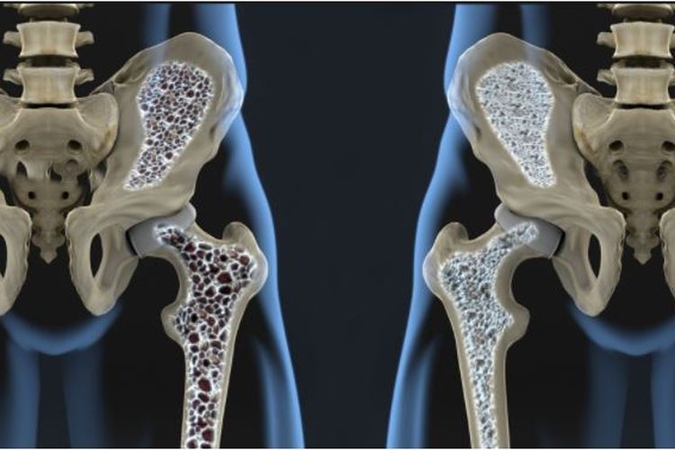 Kenali Gejala dan Cara Mencegah Osteoporosis