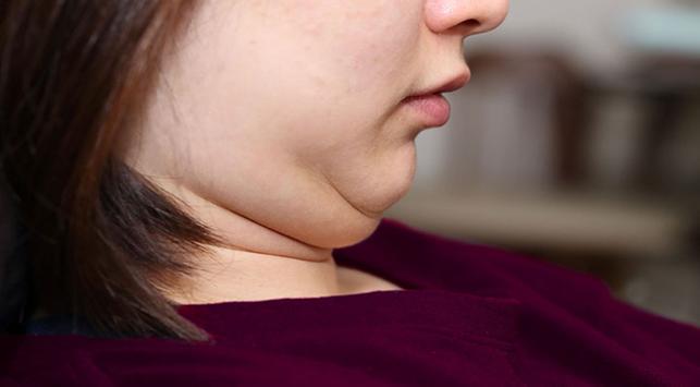 Tips Hilangkan Double Chin Secara Alami