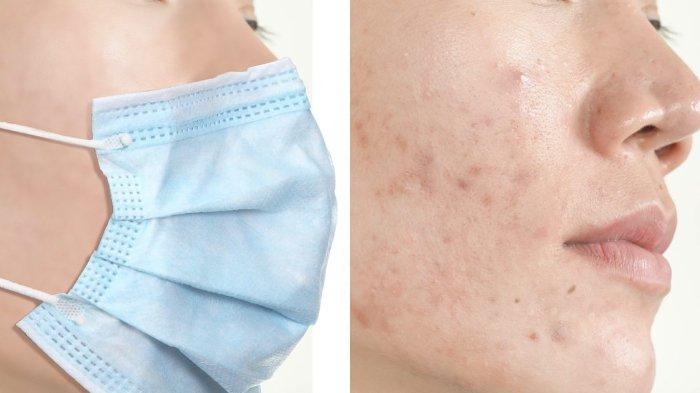 Tips Atasi Jerawat Akibat Pakai Masker