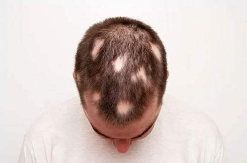 Kenali Penyakit Alopecia yang Diidap Istri Will Smith