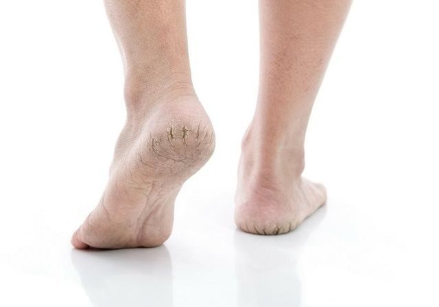 Cara Alami Atasi Tumit Kaki Pecah-pecah