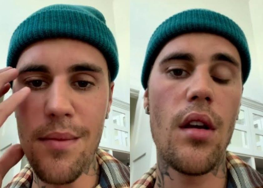 Apa Penyebab Kelumpuhan Wajah seperti yang Dialami Justin Bieber?