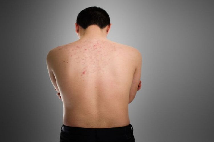 Cara Alami Hilangkan Jerawat Punggung - TIKTAK.ID