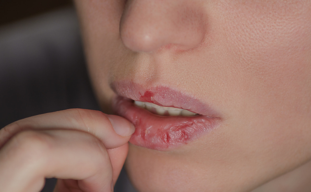 Tips Atasi Bibir Kering dan Mengelupas Saat Puasa